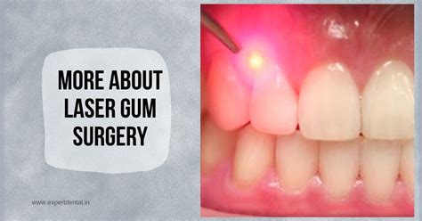 More About Laser Gum Surgery - Expert Dental Care