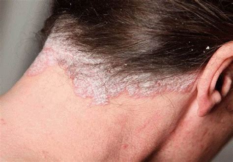 Scalp psoriasis pictures | Symptoms and pictures