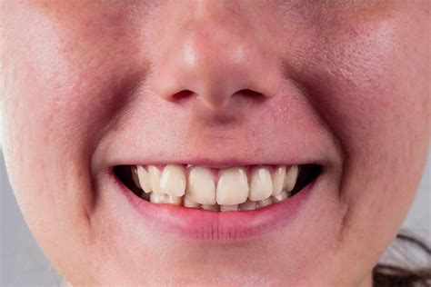 Overlapping Teeth: Why They Exist and How to Fix Them - Dental Health Clinic