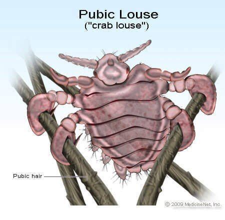 Crab louse - Alchetron, The Free Social Encyclopedia