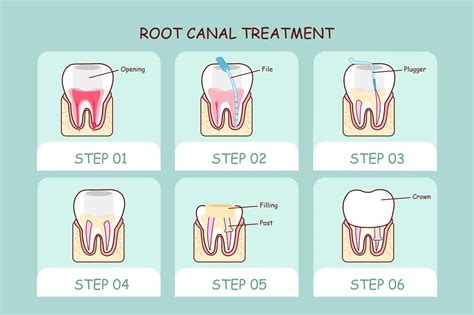 Root Canal ( Endodontics) | Marius Street Family Dental