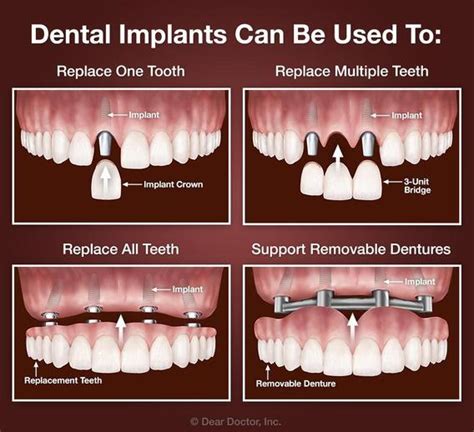 Tooth Implant Types