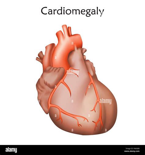 Enlarged Heart (Cardiomegaly): Causes, Treatment, And More, 49% OFF