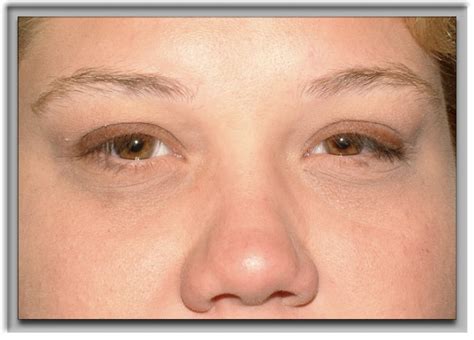 Floppy Eyelid Syndrome Surgery Denver & Aurora CO