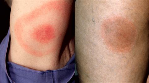 Lyme Disease Tick Bite Rash