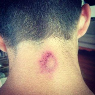 How to Treat & Prevent Paintball Bruises and Welts