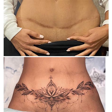 Aggregate 64+ tummy tuck tattoo - in.coedo.com.vn