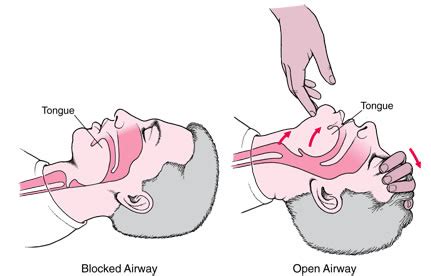 How to perform a head tilt chin lift – CPR Test