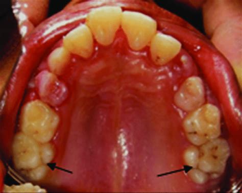 Bilateral supernumerary cusps on fi rst maxillary molars | Download ...