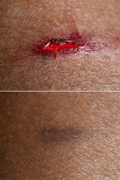 Superficial Wound before and after a Connective Tissue Treatment Stock ...