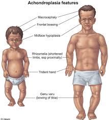 Achondroplasia - Symptoms, Causes, Complications & Diagnosis- Santripty