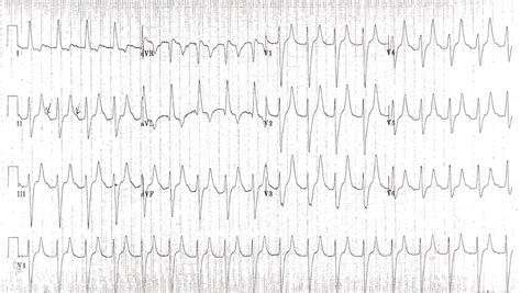 Hyperkalemia – Core EM