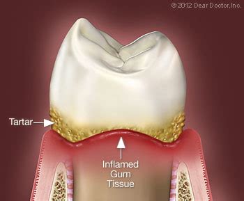 Treating Gum Disease Without Surgery | Moffett Dental Center | Harrisburg PA