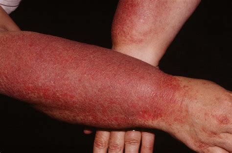 Dermatomyositis - Causes, Rash, Symptoms, Diagnosis & Treatment