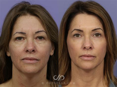 Laser Skin Resurfacing for Los Angeles & Marina Del Rey | Stoker Aesthetics