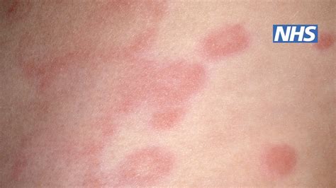 Rash In Adults