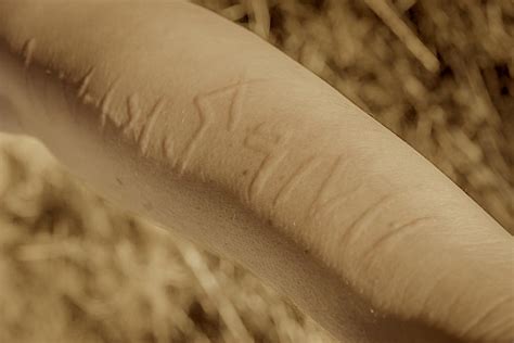 Dermatographia | Unsettling Stories