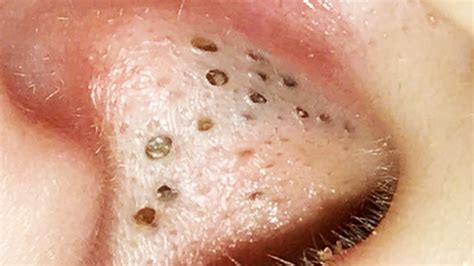 Pimple Popping 2025 Blackheads - Tommy Gretchen