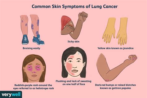 Lung Cancer Symptoms on the Skin to Watch For