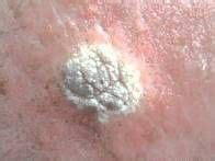 White mole on skin | Seborrheic keratosis, Skin tags on face, Skin conditions pictures