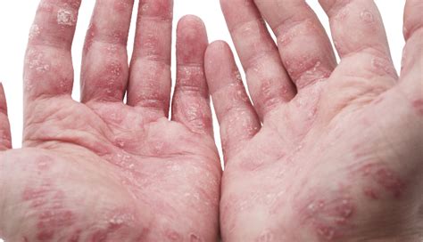 Psoriasis, psoriatic arthritis increases cardiovascular risk - The Clinical Advisor