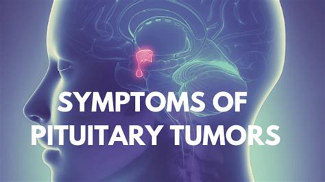 Symptoms of pituitary tumors in 2020 | Tumor, Symptoms, Pituitary gland tumor