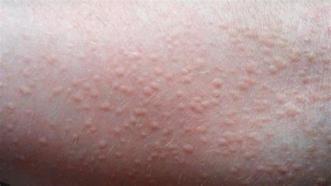 Why Is My Face Itchy With Little Bumps | Allergy Trigger