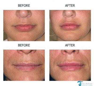 Lip Augmentation & Lip Lift Enhancements