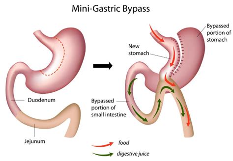 Single Anastomosis Gastric Bypass Gold Coast | Omega Loop Bypass