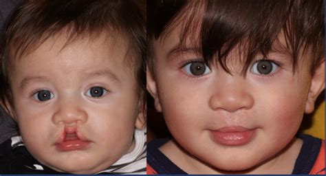 Before and After Gallery | Cleft Palate Surgeon El Paso TX