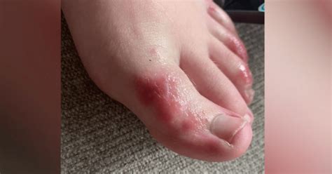 COVID toes: Mysterious rash can affect feet in patients with coronavirus | WJBF