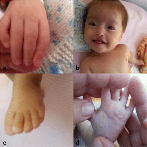 Recombinant chromosome with partial 14 q trisomy due to maternal pericentric inversion ...