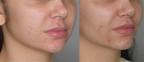 Surgical Lip Lift - Beverly Hills - $4999 - Best Lip Surgeon