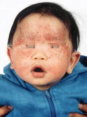 Atopic Dermatitis