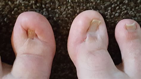 Ingrown Toenail - living with the ugliest toes in the world