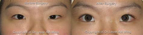 Oriental Eyelid Surgery – MSPRS