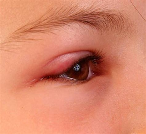 Swollen Eyelid - Symptoms, Treatment, Pictures, Causes | HealDove