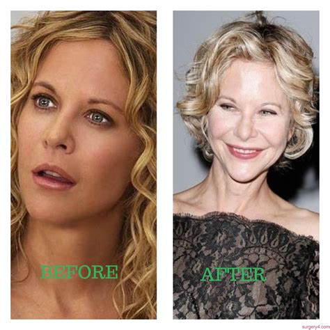 Meg Ryan Plastic Surgery Before And After Pictures 20 - vrogue.co