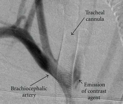 Tracheostomy Complications - The Operative Review Of Surgery