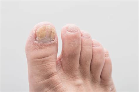 Why do my toenails look weird? | Toenail fungus causes, Toenail problems, Toenail fungus