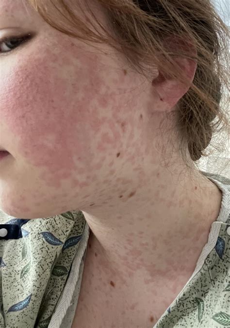 Update on “is this the rash?” : r/Lamotrigine