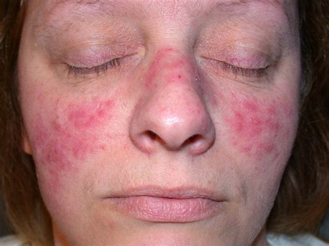 Acne Rosacea - Causes, Symptoms, Treatment, Pictures, Diet | Diseases Pictures