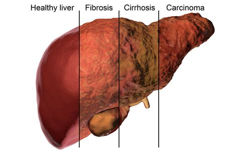 Liver Cirrhosis Stages