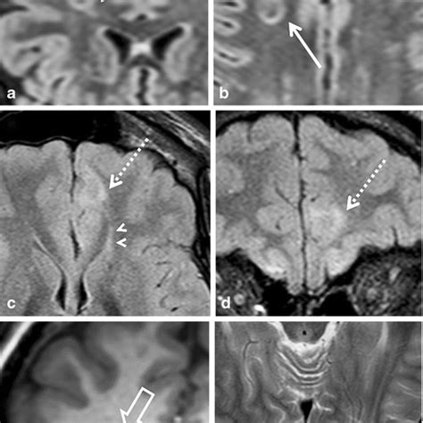 A 9-year-old girl with temporal lobe epilepsy with MRI findings ...