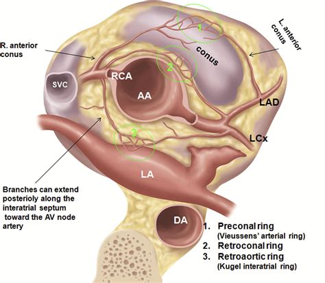 Coronary Artery Ostial Atresia: Diagnosis of Conotruncal Anastomotic Collateral Rings Using CT ...