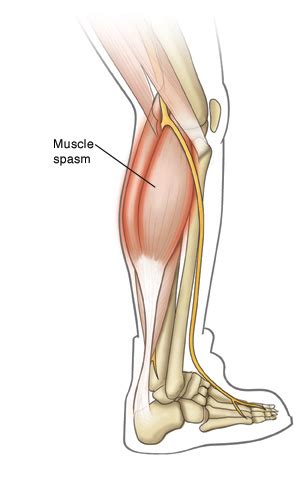 Muscle Spasm | Saint Luke's Health System