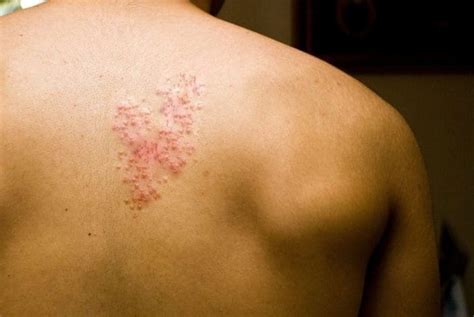 Which types of doctors can help treat shingles? - An Tâm