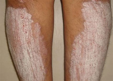 How to treat psoriasis on the legs? Photos, causes, stages and treatment | Diseases and ...