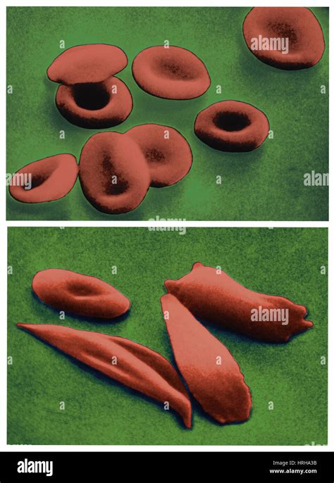Sickle and normal blood cells sem hi-res stock photography and images - Alamy