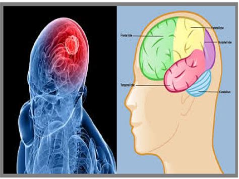 Glioblastoma or GBM Grade IV cancer: Causes, Symptoms and Treatment